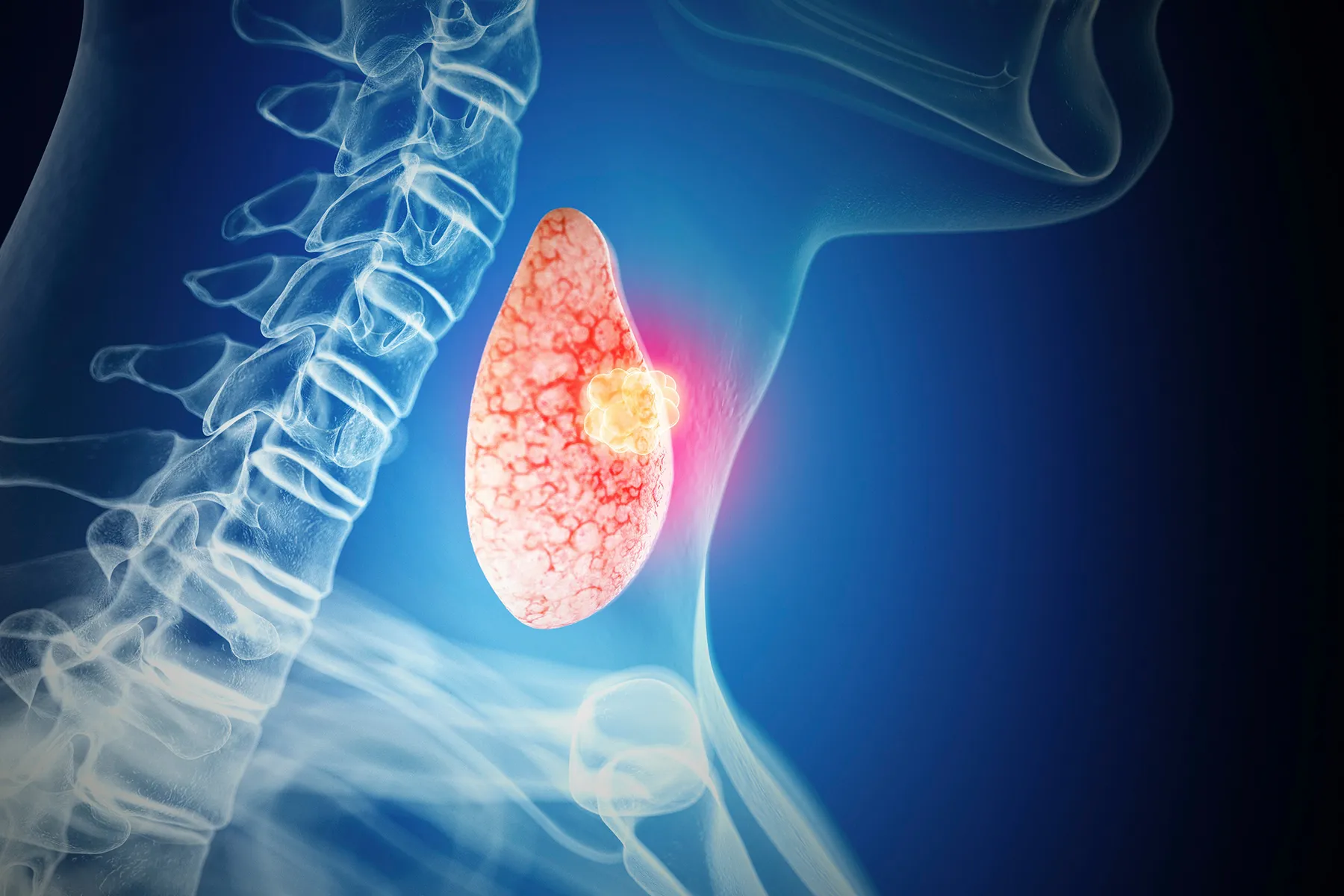 Thyroid gland and thyroid nodules medical illustration