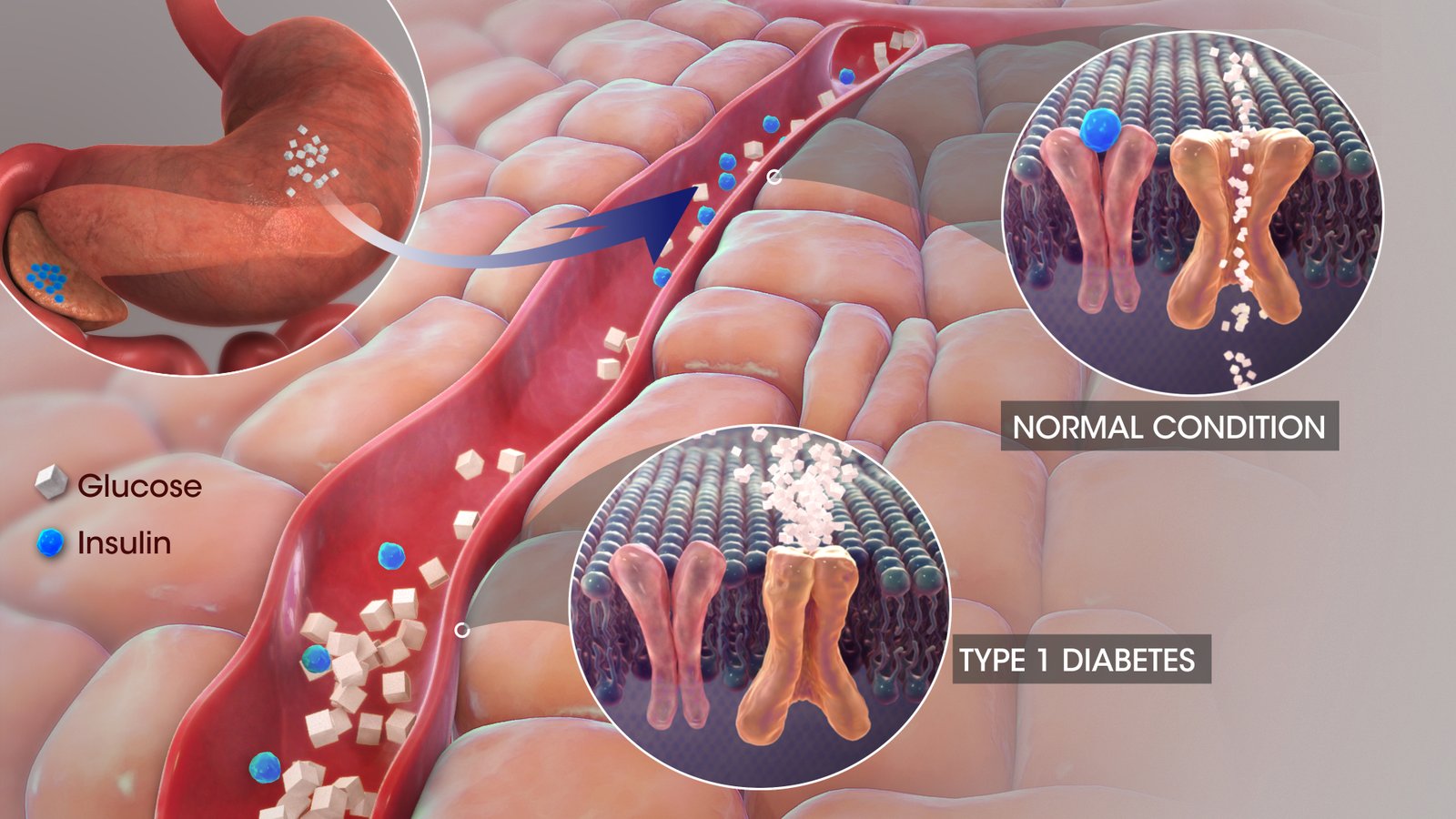 Type 1 Diabetes