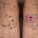 Early Stage Diabetic Foot Ulcer: Treatment | Dr. Ali Dubai