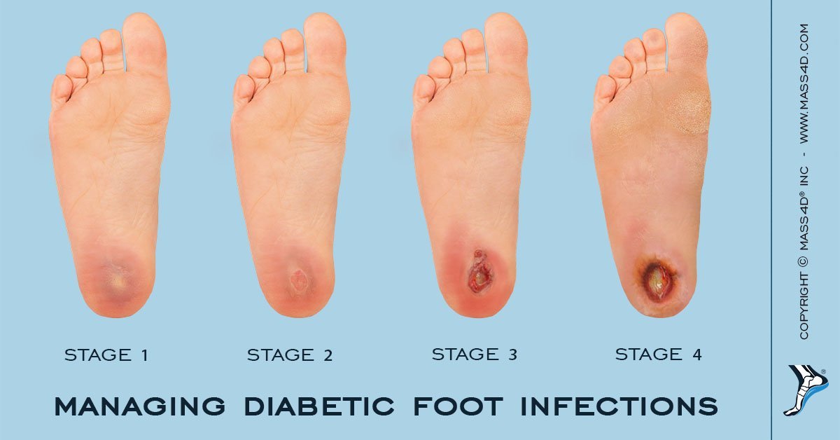 Diabetic Foot Disease