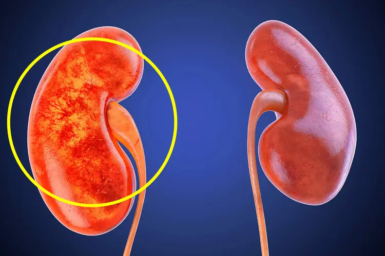 Diabetic Nephropathy