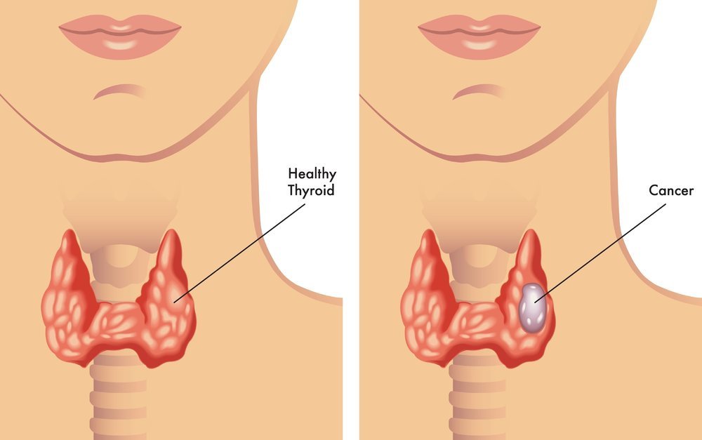Thyroid Nodules and Cancer
