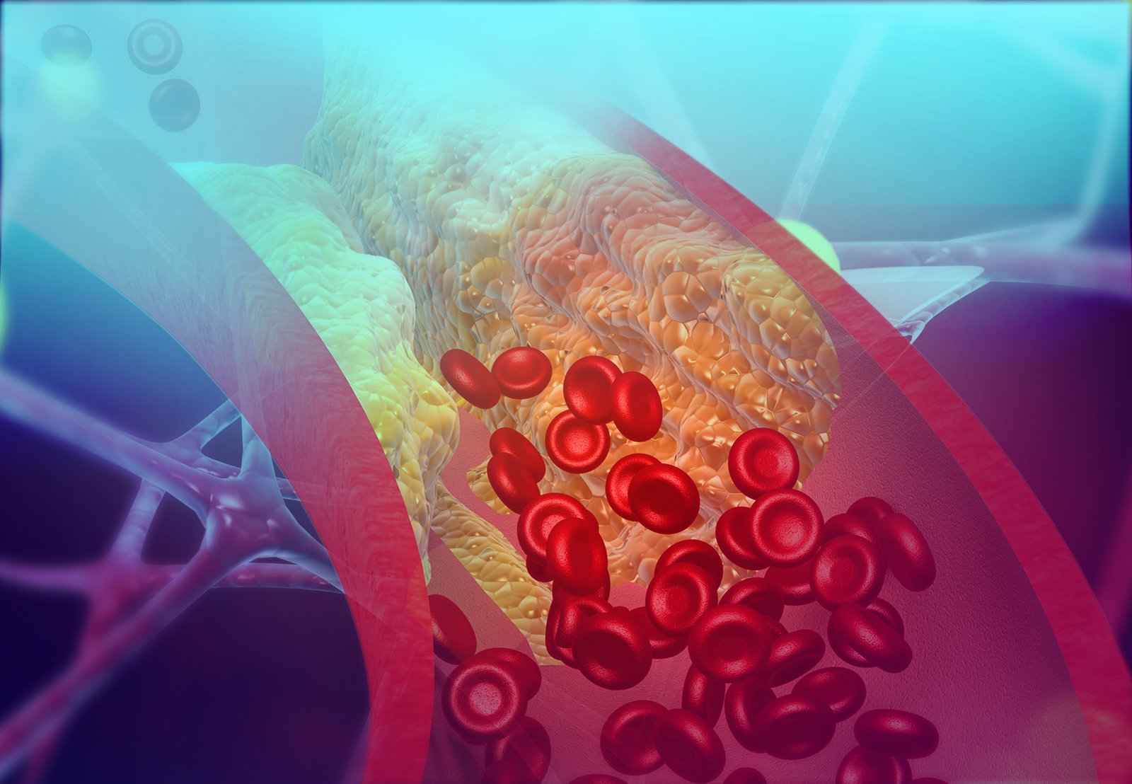 Type 2 Diabetes