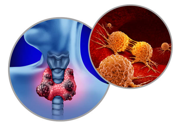Radioactive Iodine Therapy