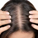 Pcos hair loss regrowth: Expert Strategies from Dr. Ali Aldibbiat in Dubai