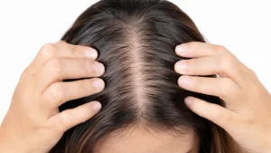 Pcos hair loss regrowth: Expert Strategies from Dr. Ali Aldibbiat in Dubai