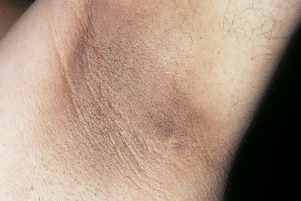 Dark Skin Patches