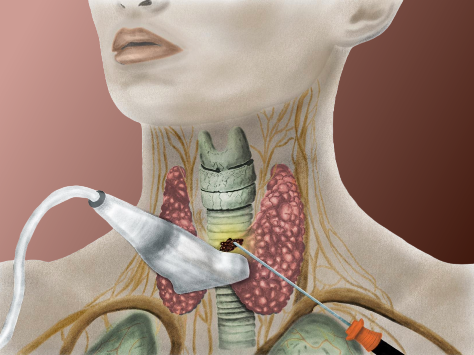 Thyroid Surgery