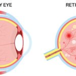 Diabetic Neuropathy UAE: Causes, Symptoms, and Treatment Guide