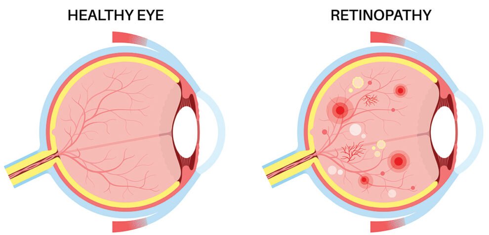 Diabetic Retinopathy