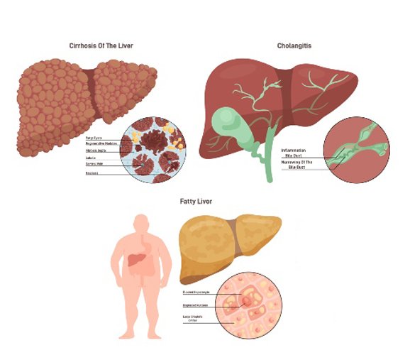 Fatty Liver Disease