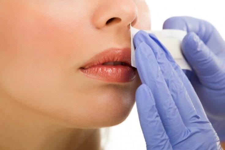 Hirsutism Clinical Case