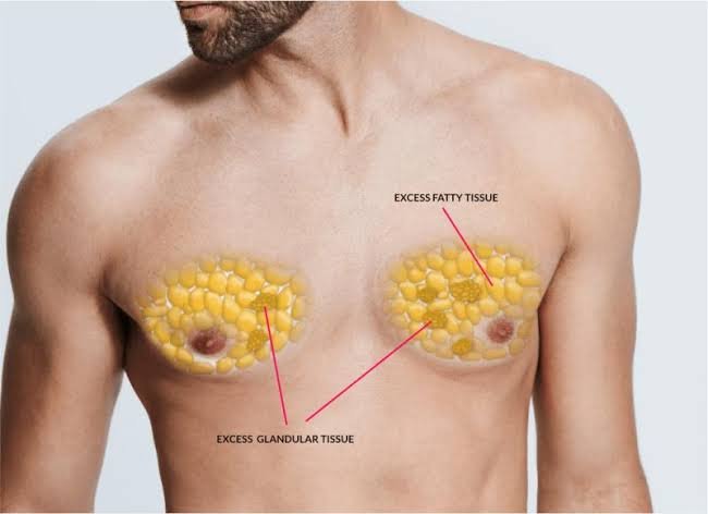 Gynecomastia