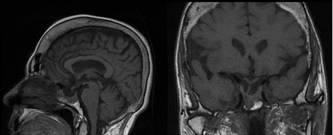 Growth Hormone-Secreting Pituitary Adenoma