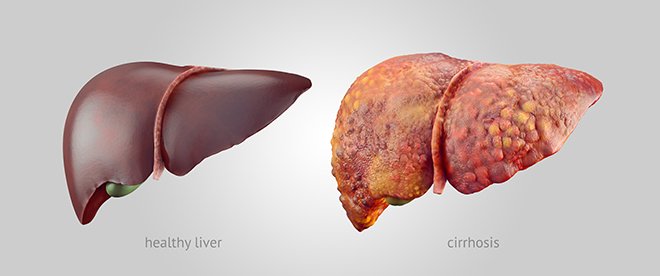 Cirrhosis Scarring Progress