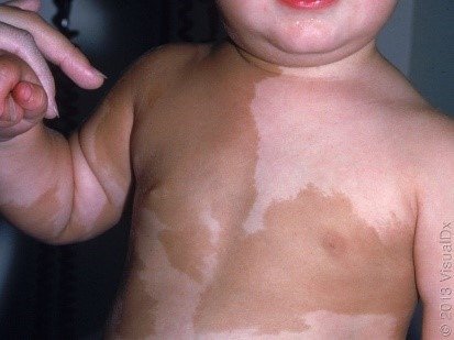 McCune-Albright Syndrome