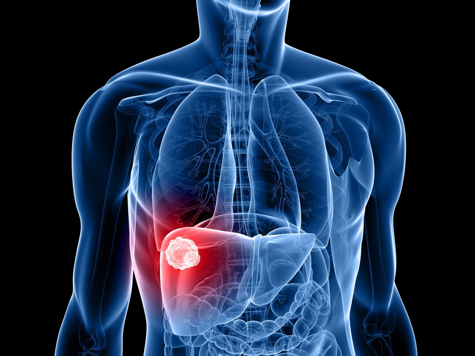 Hepatocellular Carcinoma / Liver Cancer