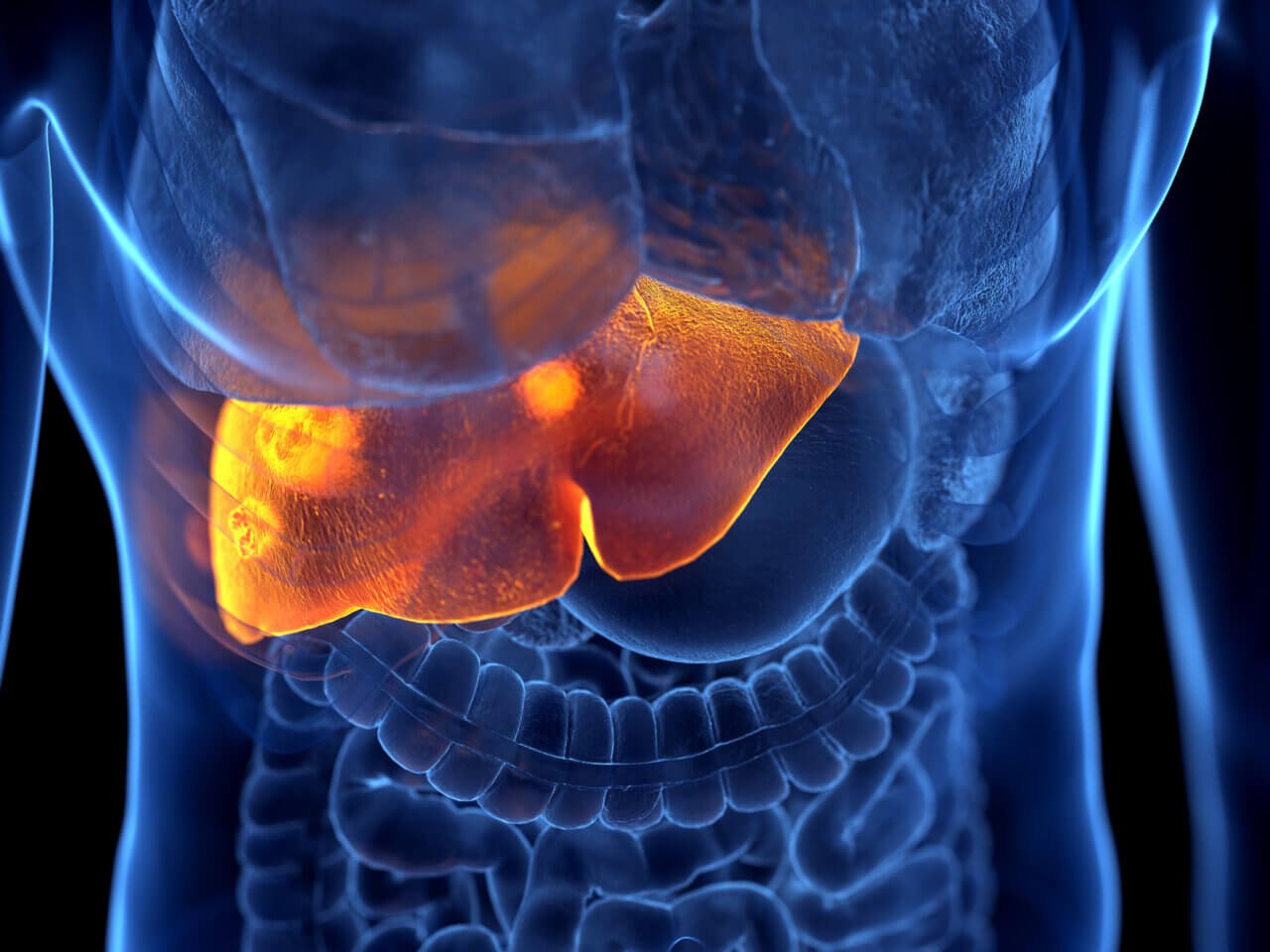 Resmetirom for Confirmed MASH with Fibrosis
